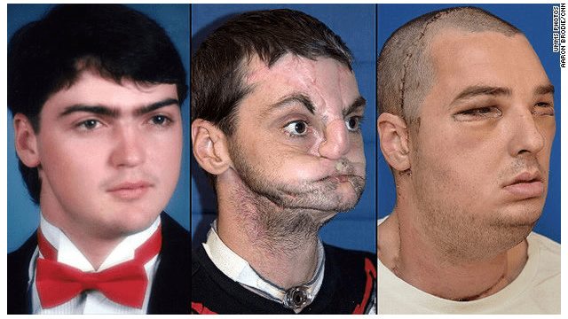 Historia y vídeo de luna persona que recibió un trasplante de rostro 1