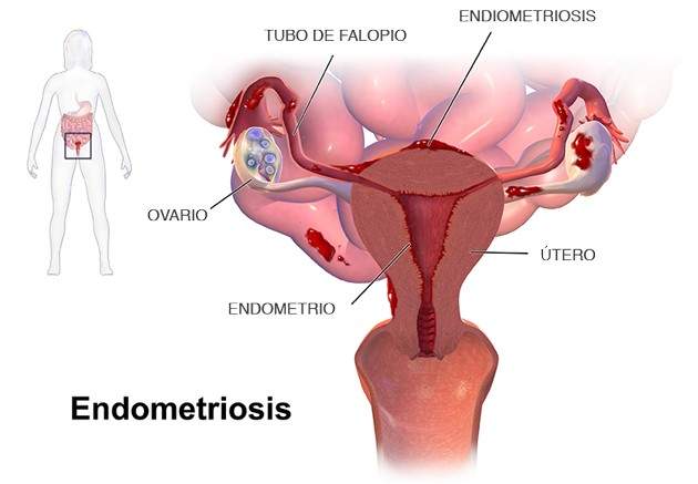 Endometriosis 3