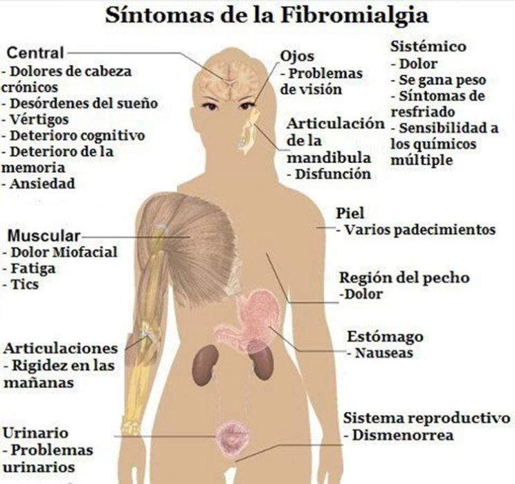fibromialgia 1